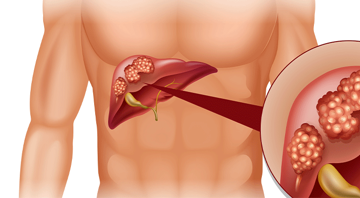 Top Consulting Physician in Pune for Treating Liver Diseases 
