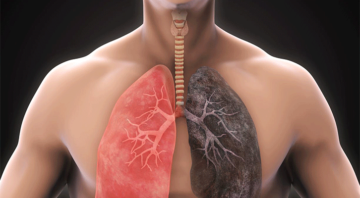 Lung Diseases Treatment in Pune by Dr. Komal  P. Bamnodkar.